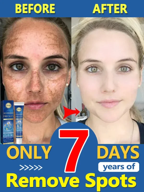 Freckle Whitening Cream Removal Dark Spots Melasma