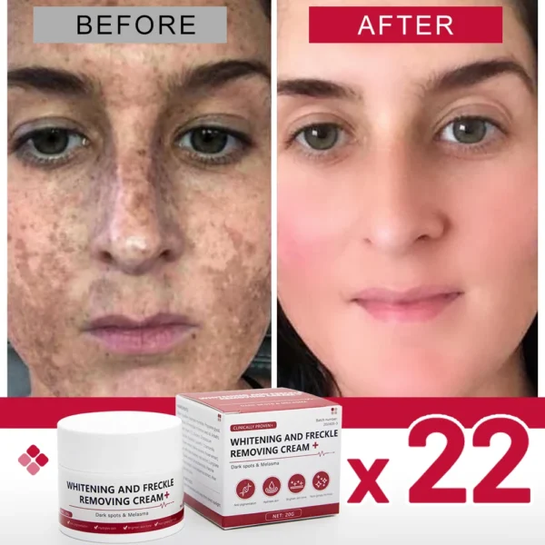 Whiten Freckle Cream Brighte Remove freckle Dark Spot Melasma removes facial spots spots Improve dullness
