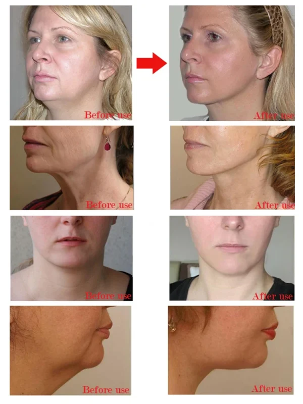 V face cream double chin elimination V line - Image 4
